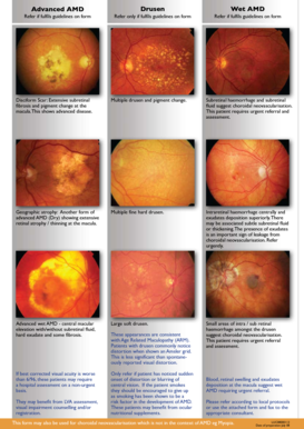 Wet AMD Rapid Access Referral Form